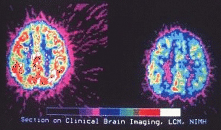 ADHD Pet Scan